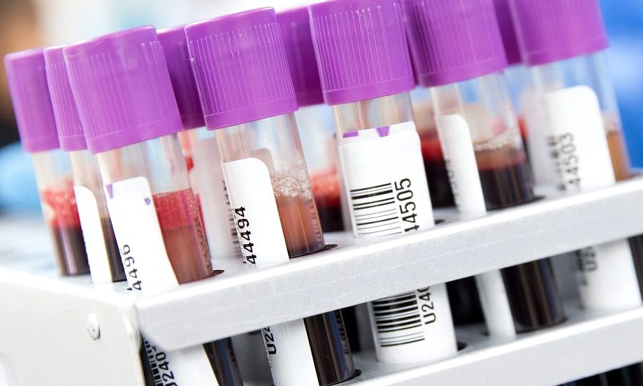 Stock photo: Blood samples. University of Turin investigators, partners on the IDI-led consortium CAPA-CT II, are the first to openly publish a method for quantifying remdesivir in blood.